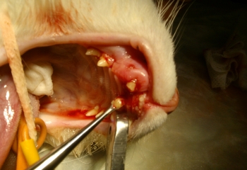 Grave parodontopatia focale da frattura dentale subita molto tempo prima 